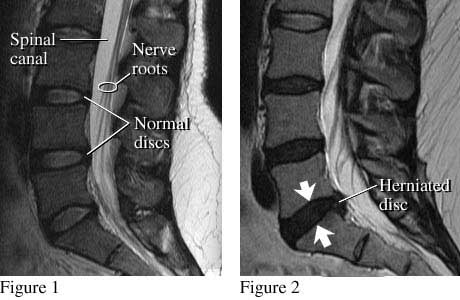 herniated-disc